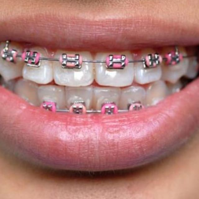 Fake Braces Are a Fashion Trend Among Youngsters in Southeast Asia