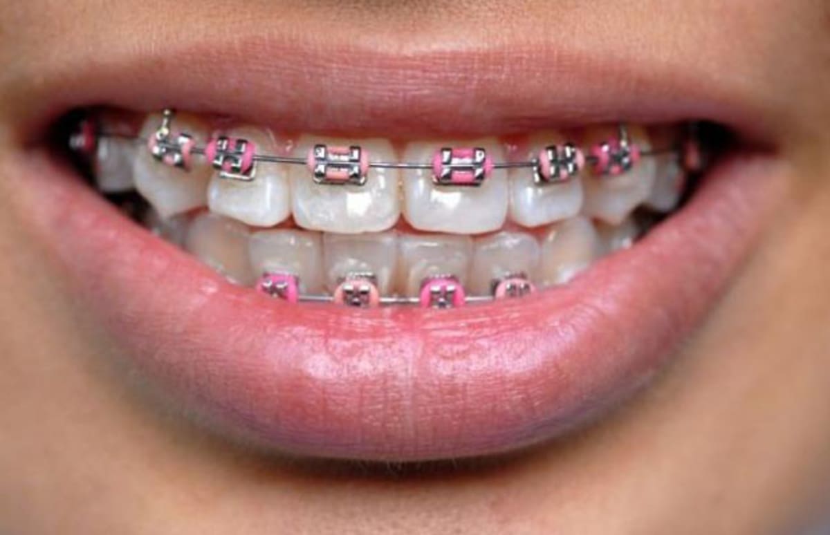 Fake Braces Are A Fashion Trend Among Youngsters In Southeast Asia 