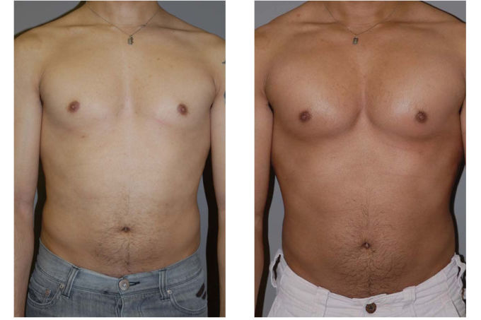 Muscle Implants The Most Ridiculous Surgeries Men Pay For To Look