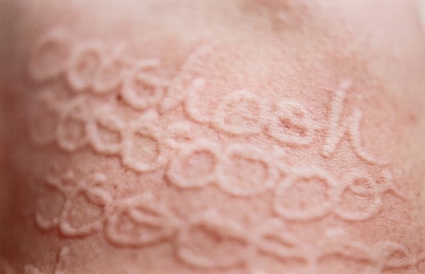 Skin writing disease