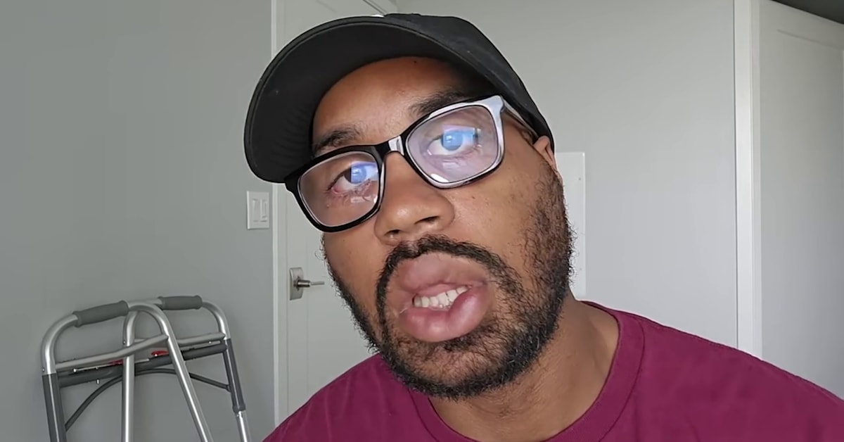 Comedian LongBeachGriffy Gives Update After He Broke His Face Jumping ...