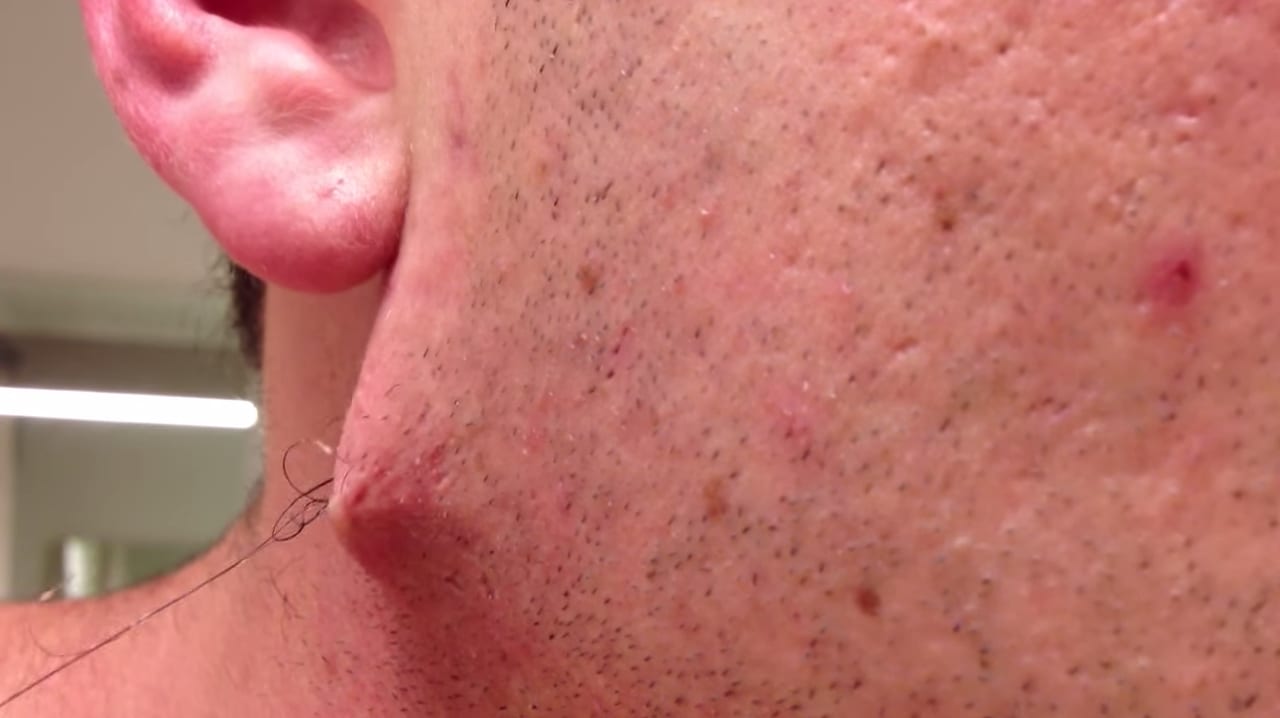 Man Pulls Longest Most Revolting Ingrown Hair Out Of His Face