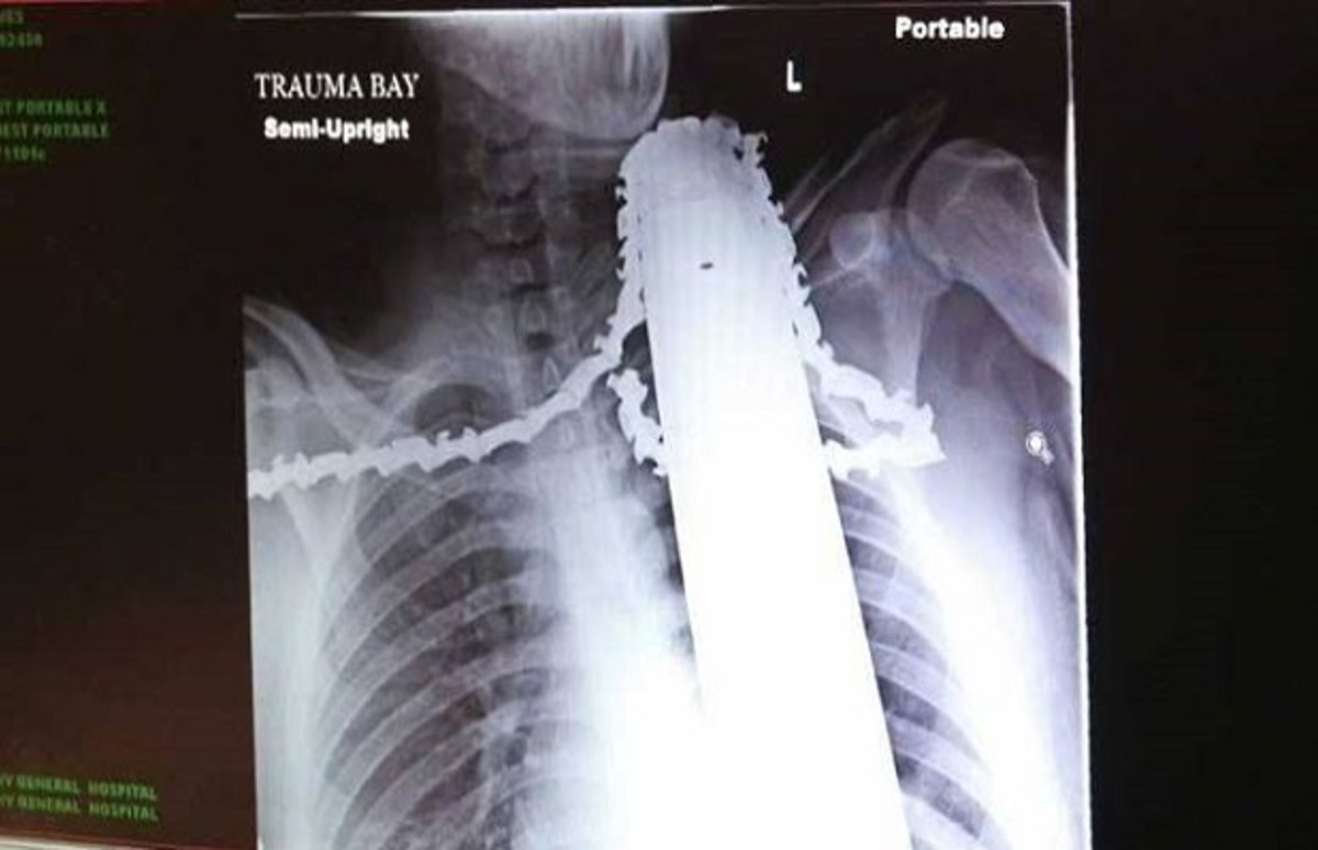 Freak Accident Leaves Pittsburgh Man with Chain Saw Blade Stuck in Neck Complex