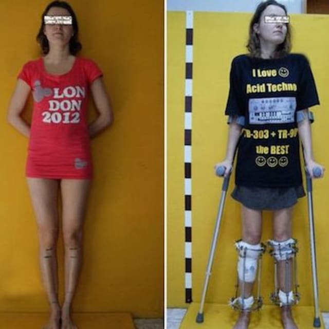 Aspiring Model Gets Leg Surgery To Increase Her Height To Industry