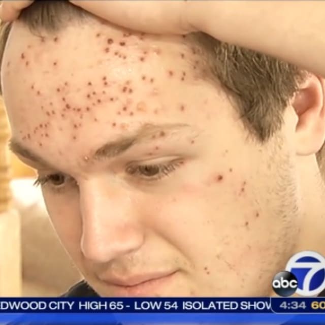 California High School Wrestler Claims He Contracted Herpes During