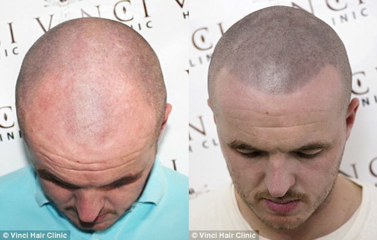 bald guys are discovering micro scalp pigmentation complex bald guys are discovering micro scalp pigmentation complex