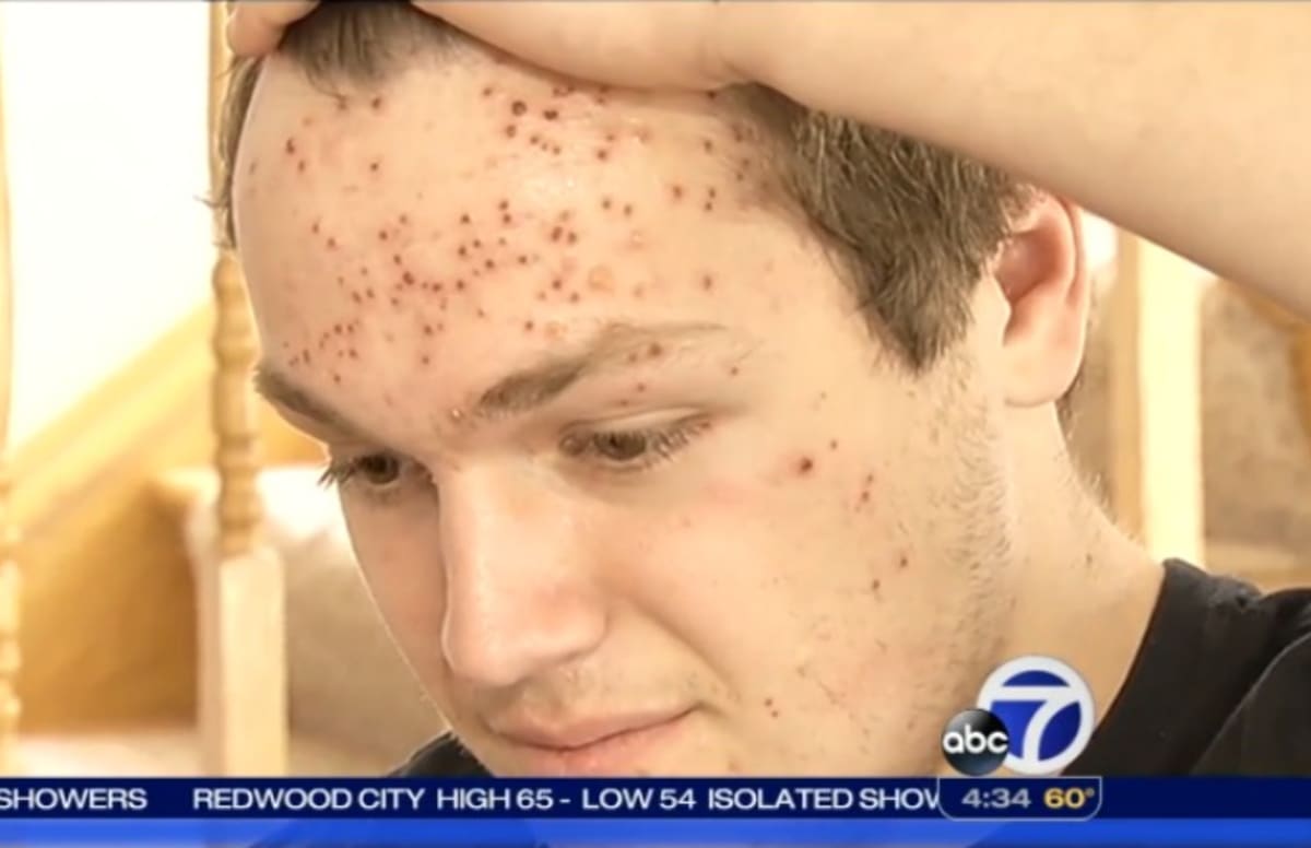 California High School Wrestler Claims He Contracted Herpes During Match | Complex1200 x 776
