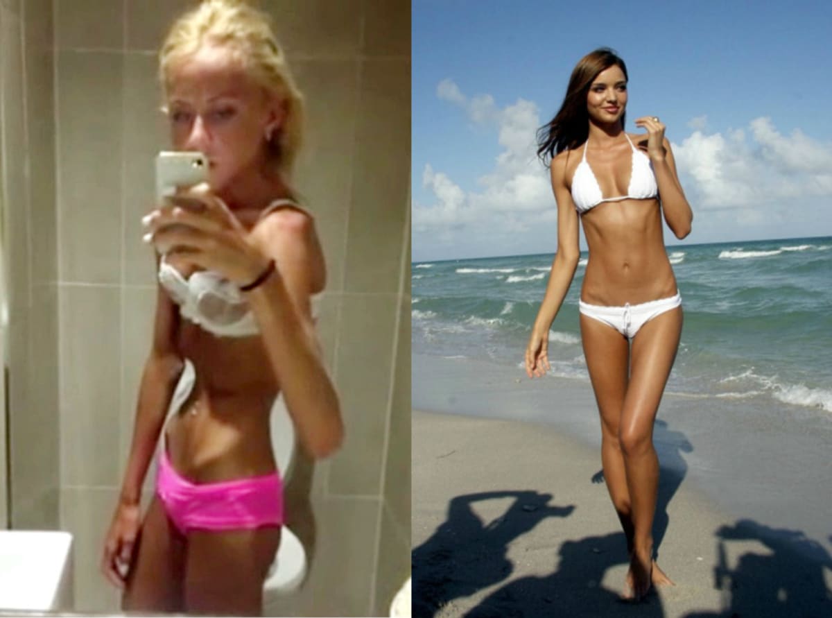 Woman Becomes Anorexic To Look Like Models Complex