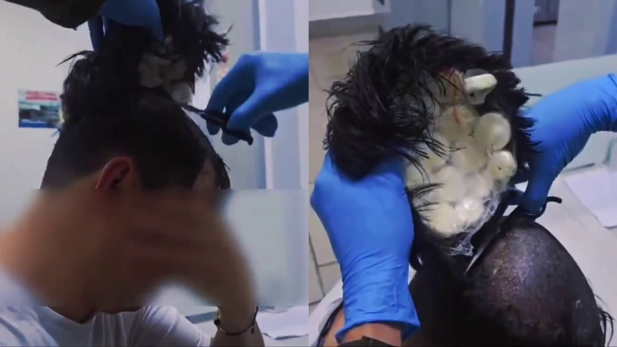 A person with a wig being removed by someone wearing a police officer blue gloves, revealing hidden cocaine capsules underneath.