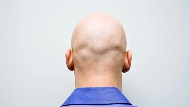 U.K. employment ruling determines calling a man "bald" is sexual harassment