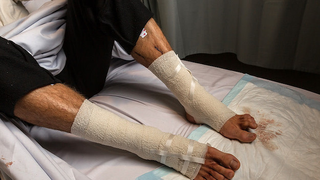 Buruli Ulcer Disease Australia