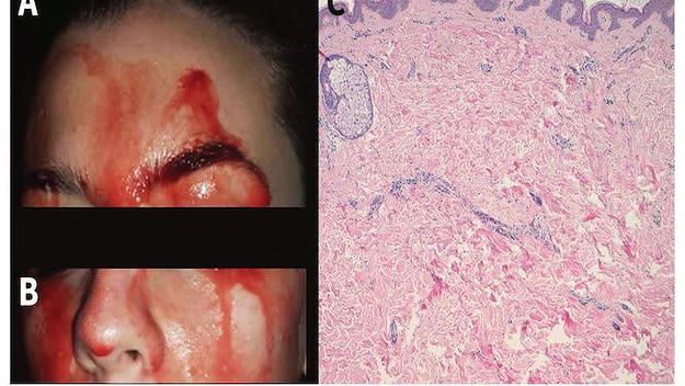 Patient in Italy has rare condition that makes her sweat blood.