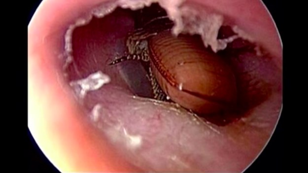 Cockroach in ear