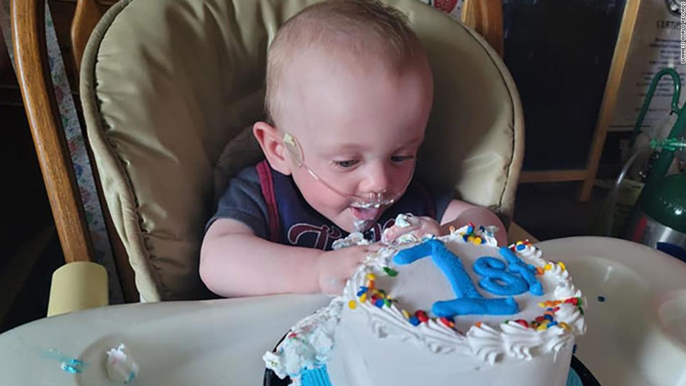 World S Most Premature Baby Turns One After Given No Chance Of Survival Complex