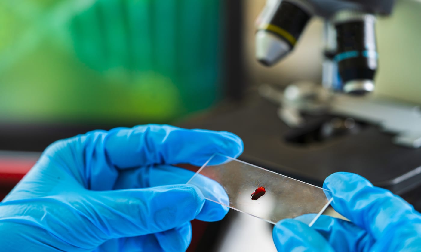 HIV cured in woman via umbilical cord blood